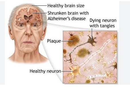Alzheimer's Disease New Drug Leqembi lecanemab-irmb Reduced Amyloid beta plaque Alzheimer's Disease New Treatment Medicine 
