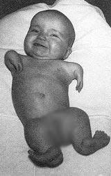 Thalidomide The Drug That Caused Limbless Babies Tragedy