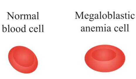 Pernicious anemia causes and treatment